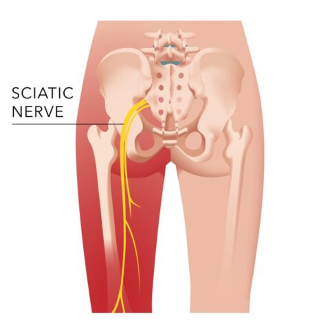 برنامج تأهيل مشاكل عرق النسا Sciatica rehabilitation program