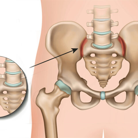 تأهيل مشاكل المفصل الحرشفي Sacroiliac Joint Dysfunction Rehab