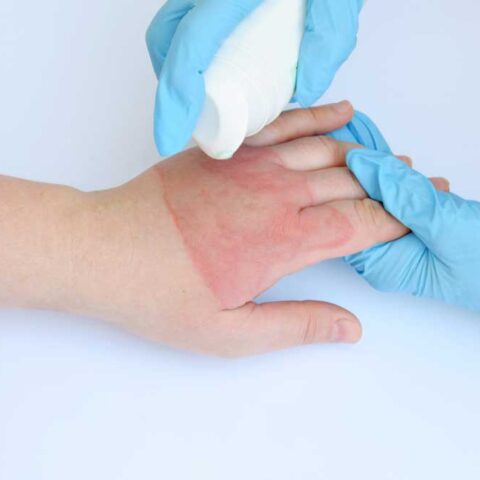 تأهيل مابعد الحروق Post Burn rehabilitation program