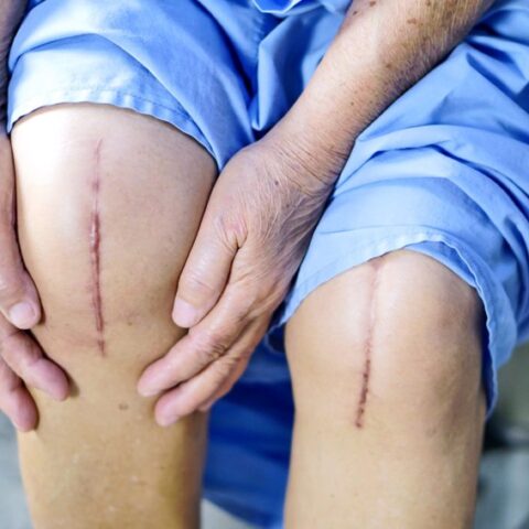 برنامج تأهيل الوذمة اللمفاوية lymphedema management program