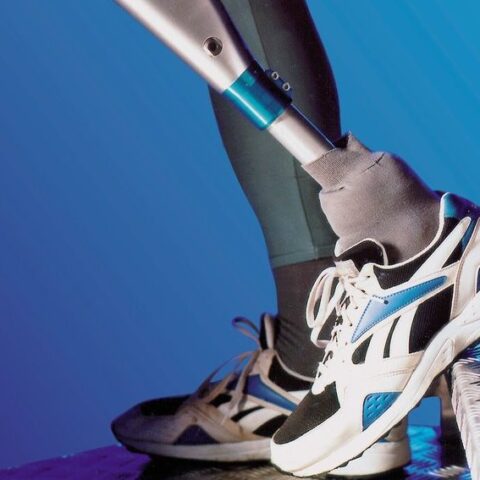 برنامج تاهيل البتور والاطراف الصناعية Amputee rehabilitation program
